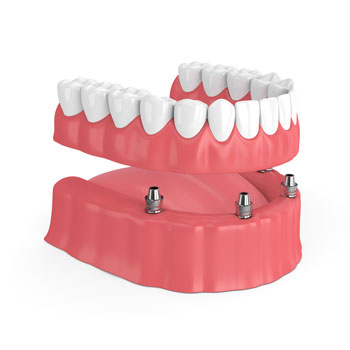 implant-supported-denture implant-supported-denture