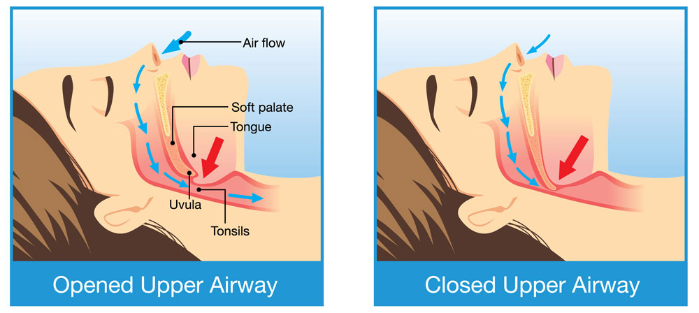 Sleep Apnea Illustration